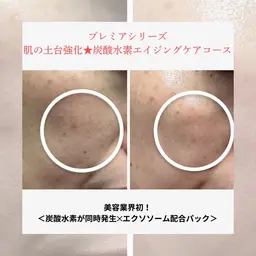 肌の土台強化★炭酸水素エイジングケアメニュー