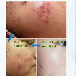 最新スピキュール入りハーブピーリング🌿ニキビ、ニキビ後、毛穴開き、くすみ、ざらつき、毛穴黒ずみ✨￥9800→￥8800