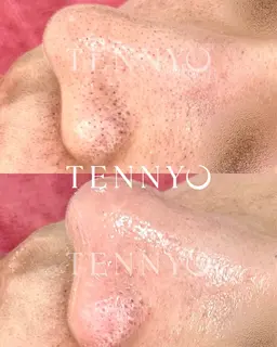 【男性限定】TENNYO毛穴洗浄◆15400→