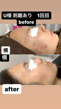 剥離あり【ニキビ、ニキビ跡にお悩みの方に】フェイシャルハーブピーリング ♪ メンズの方は絶対に剥離あり◎15000円