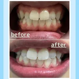 【【超破格!!】】🌟minimo限定🌟セルフホワイトニング初回お試し¥3000 平均4トーンアップ💎