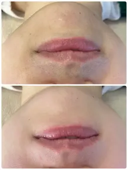 お顔の産毛スッキリ✨フェイシャルワックス🌿