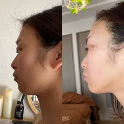 【人気No1】生プラズマ、ヒト幹細胞培養美容液導入肌改善フェイシャル