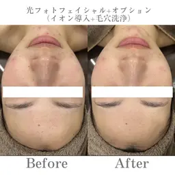 トータル美肌ケア🫧コラーゲンリフトアップフェイシャル(美容液導入付き)