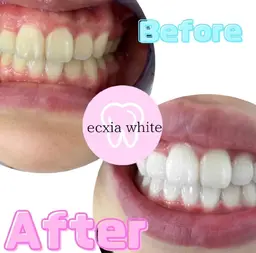 【minimo掲載記念】セルフホワイトニング(9分×2回)￥980 別途料金なし！！