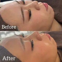 お顔剃り(フェイスシェービング)💆🏼‍♀️💎✨