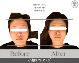 【小顔リフトアップ＋ヘッドスパ】小顔矯正×細胞レベルに働きかける高機能ジェルで徹底ケア✨ヘッドスパでさらに引き上げ⤴️