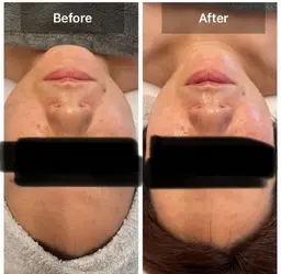 🌟小顔リフトアップトリートメント🌟2回目から4000円(現金でのお支払い)