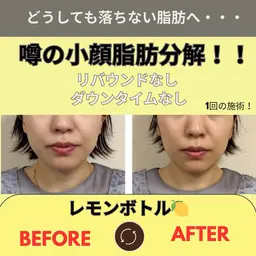 【結果重視】最新マシンで導入レモン　ボトル【横顔美人】キレイなフェイスラインへ！フェイスマスクつき