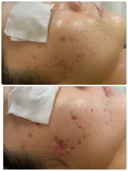 【ニキビ跡ケアに最強、30日急速肌再生✨】5年あったニキビが😲レチノールピーリング1ヶ月✖️5回