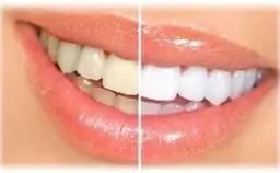 ☆学割☆1回で分かるホワイトニング体験♪1回分🙆