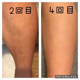 全身脱毛（VIOあり）