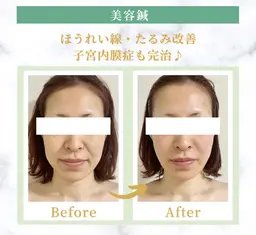 【ベーシック美容鍼】小顔効果抜群❣️しみシワ・たるみ・肌トラブルまで全部改善♪♪表情筋にアプローチする事で顔が上がる⤴️