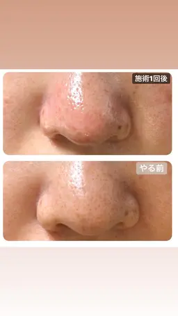 エステ 【エクストラクション毛穴洗浄エステ】