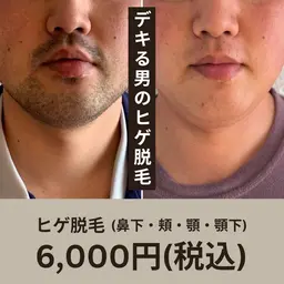 大人気ヒゲ脱毛