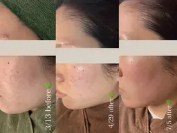 【60%off】エステペン＋ハーブピーリング