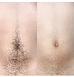 激安価格！きちんと抜ける！女性全身脱毛vio顔込み