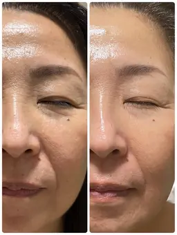 艶肌コース　韓国式肌管理ララピール　50分　専用ウォッシング・専用ピール２種・専用ゲルパック