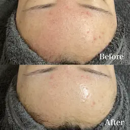 🔮【ニキビ・赤み・小顔ケア】 REVIハーブピーリング《陶肌トリートメント》 ➕ IPSPセラム➕VCF0.4ml