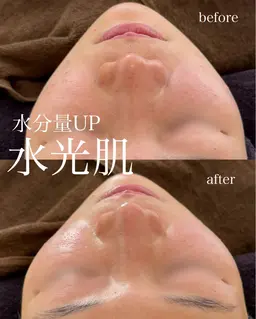 《高保湿》乳酸ピーリングフェイシャルエステ60分/クリスティーナ/アンストレス/バリア機能強化/ニキビ/揺らぎ肌