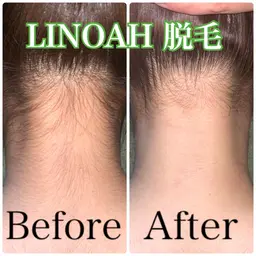 ◎12月限定◎【背中ニキビケア/毛穴】 背中全体+うなじ脱毛 ¥14960⇒¥5980