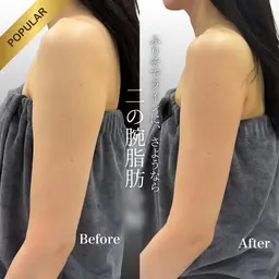 【人気No.1】5cc | 顎下・二の腕・部分集中サイズダウン🔥