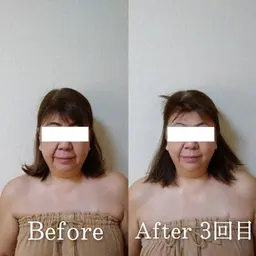 小顔矯正65分✕5回コース