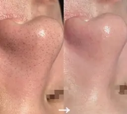 韓国毛穴洗浄(毛穴光フェイシャル+ヘッドマッサージ付) +角質ケア 60分