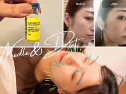 【脂肪がなくなる!?美容鍼】鍼灸初！脂肪サヨナラ👋美容鍼｜クリニックじゃなくて夢は叶う✨両頬・二重顎をスッキリ！