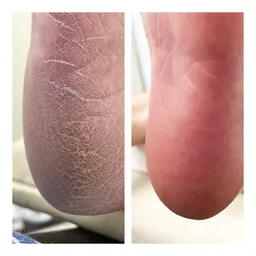 フット角質ケア