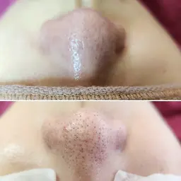 小鼻の黒ずみ集中ケア🫧毛穴エクストラクション！黒ずみ、ザラザラもツルツル小鼻に✨