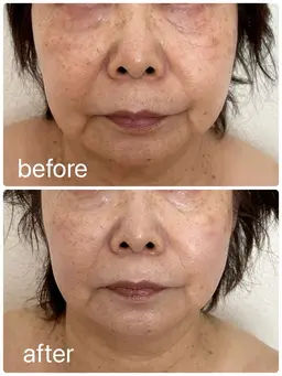 お肌のボリューム不足/ほうれい線が目立つ/ゴルゴラインやマリオネットラインが気になる/フェイスラインがすっきりしない