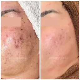 メンズニキビ|大人ニキビ|肌荒れ|誰にも相談できない繰り返すニキビ|男性の為のニキビケア体験✨