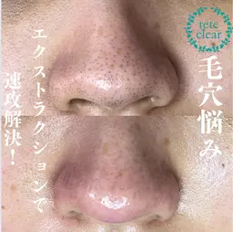 【取れた角栓が見える★】ミニモ限定★毛穴エクストラクション+その場で作る生パックプレゼント