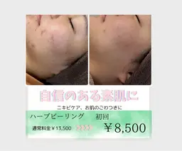 《肌質改善/肌管理》特許取得◎天然成分のハーブピーリング  70分