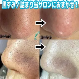 【手軽に♪】黒ずみ・詰まり撃退！鼻特化ケアコース（マッサージ無し）