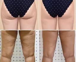 【痩身】オンダボディ:下半身痩せの救世主!痩身はもう冷却脂肪の次の時代へ ※2箇所