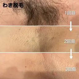 【リニューアルオープン価格】　⭐️男性両腕脱毛（ワキ、肘下、肘上）