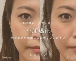 ✨即効小顔✨最強小顔矯正💎　美容整骨矯正　\6600　[福岡/赤坂]
