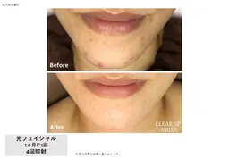 ＼ニキビ肌改善にも✨／光造顔フェイシャル🫧