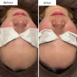 WAX脱毛＊フェイシャル