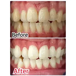 【人気No.1👑】90%の方が選ぶ🔥30分×8来店(1回あたり約4,000円)セルフホワイトニング🦷🔥