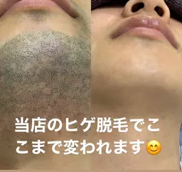 【メンズ脱毛】人気No1 初回お試しヒゲ脱毛！髭をなくして髭剃り卒業しましょう！髭剃りしたくない！モテたい男子はこれ！