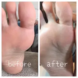 フット⭐︎足裏角質ケア