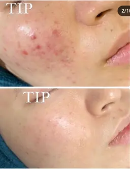 【剥離ありハーブピーリング🌿】根本改善 ニキビ・ニキビ跡・毛穴のお悩み・ハリ・キメ・美白