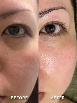 【頬、鼻周りのひらき毛穴が気になる方はこちら💁‍♀️】ひらき毛穴改善フェイシャルコース