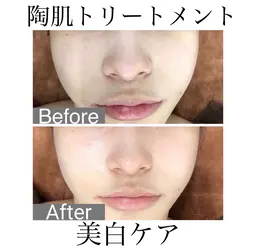 【ミニモ限定💡ハーブピーリング】美白ケア