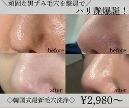 【毛穴黒ずみ撃退💥】韓国式美肌毛穴洗浄　全顔🇰🇷💕