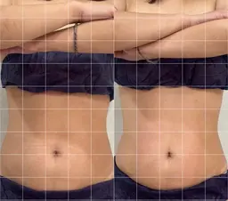 【痩身】【お腹】ぽっこりお腹が気になる方に🔥