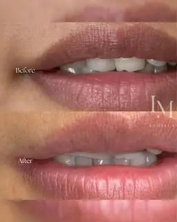 \韓国シェアNO.1/話題のLÉMELLA（ルメラ）メラニンケアモニター価格【唇】